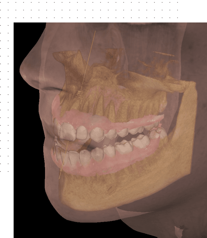 A picture of an open mouth with teeth missing.