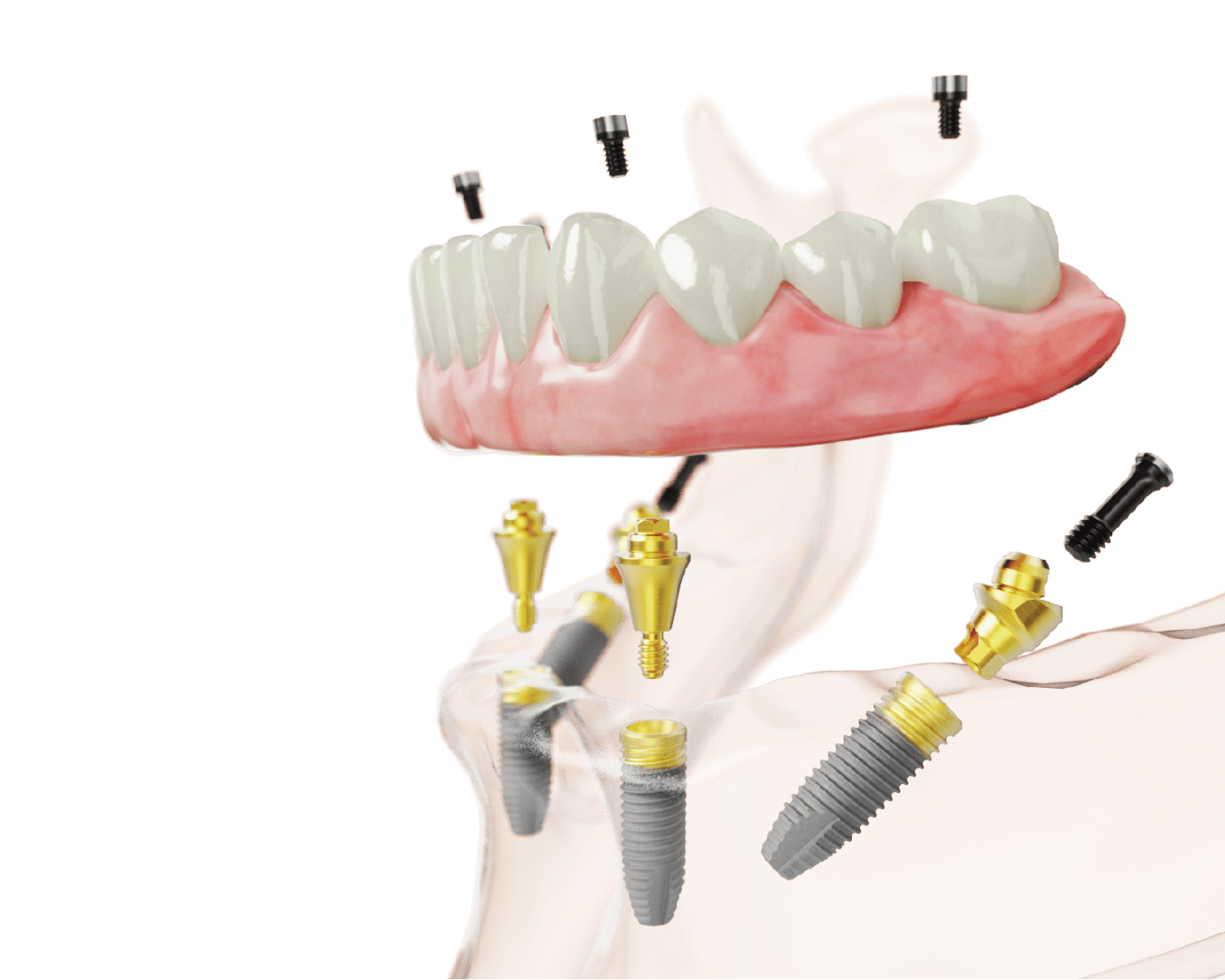 A picture of an implant supported denture.