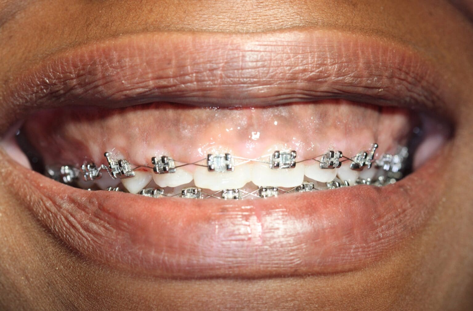 A close up of the teeth with braces on them