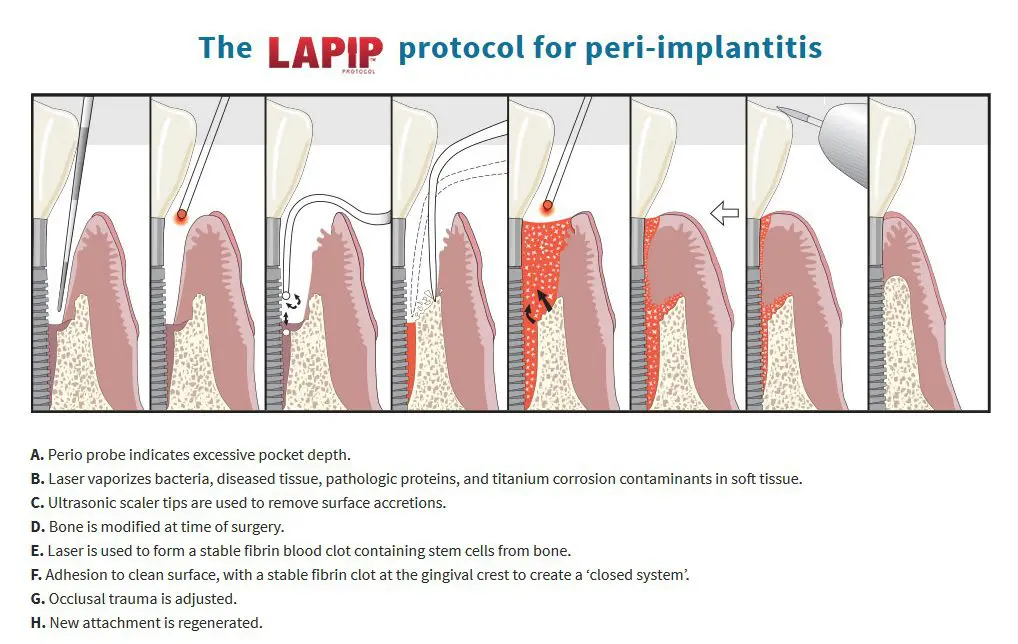 A diagram of the process of periodontal implant placement.