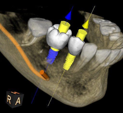 A 3 d image of the teeth and implant