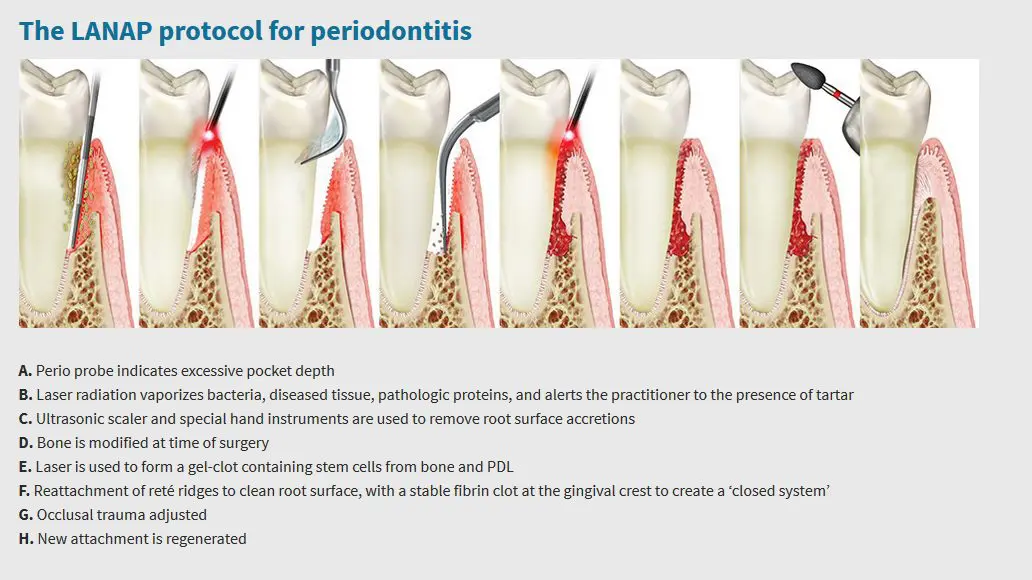A picture of the process of periodontal disease.