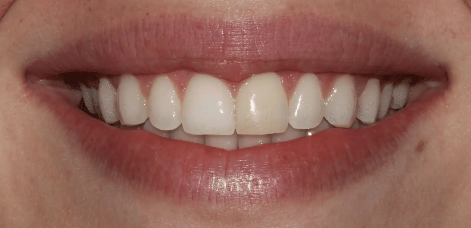 A close up of the teeth with white teeth