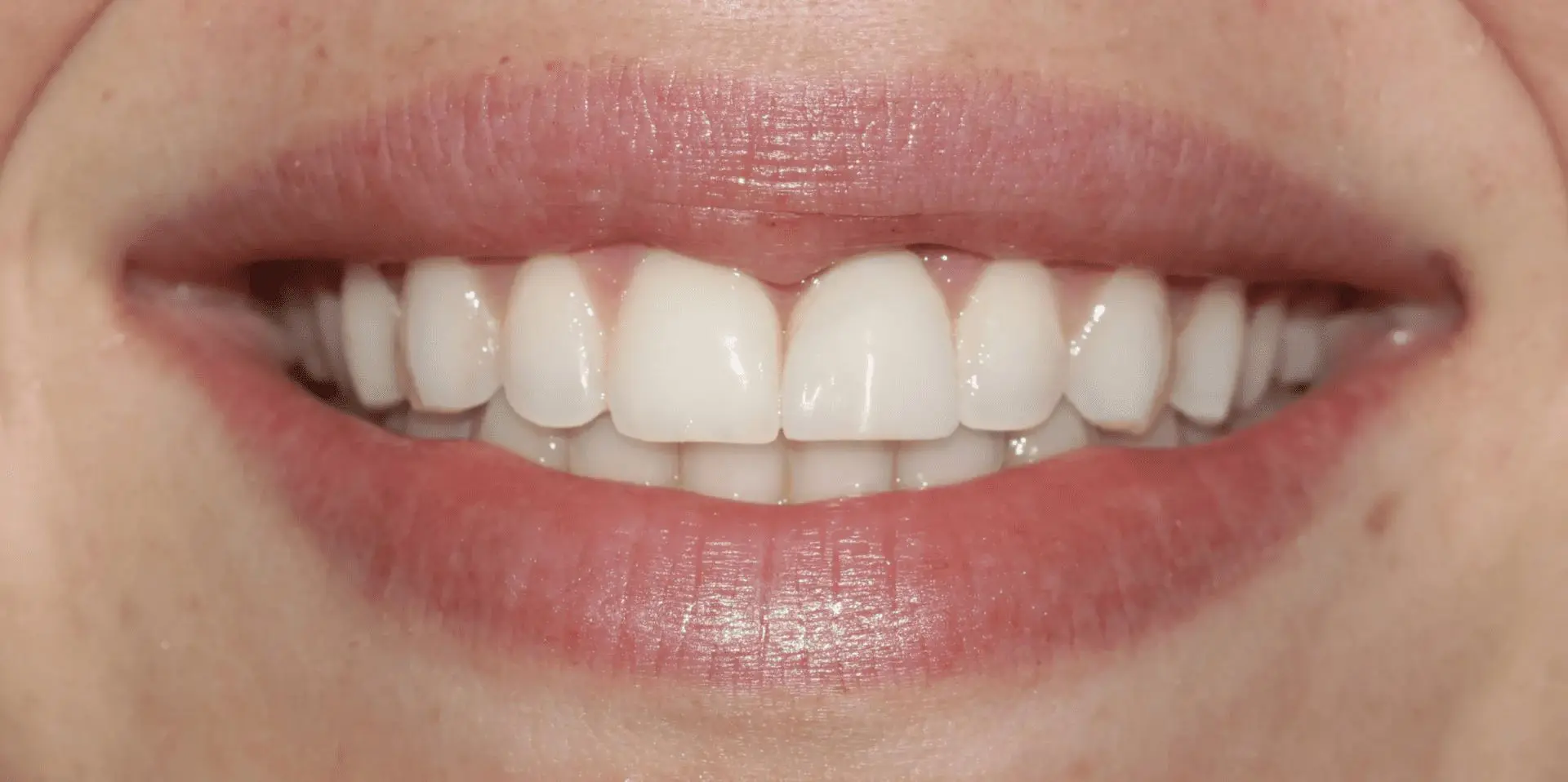 A close up of the teeth and smile of a woman