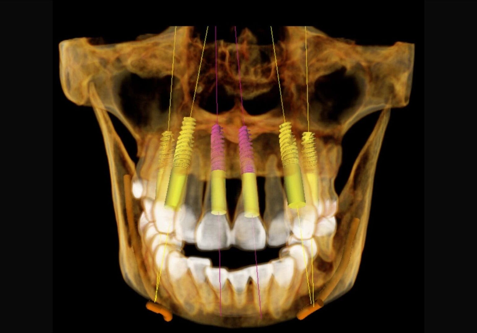 A picture of an x-ray image of teeth with different colors.