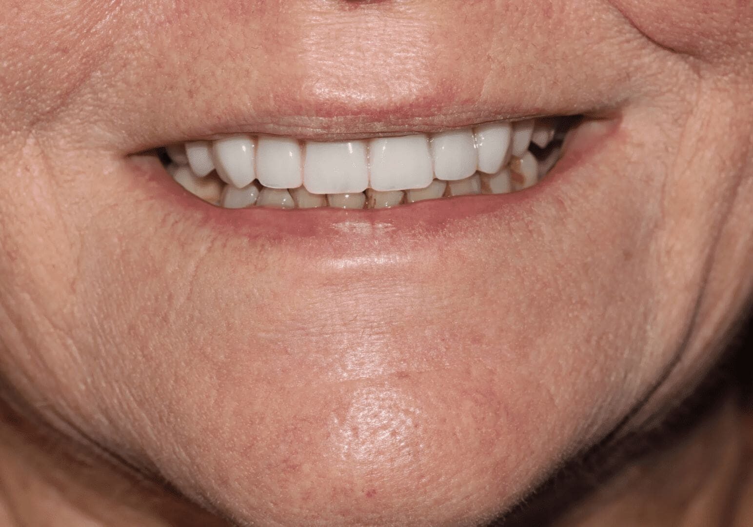 A close up of the teeth of a woman